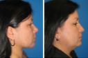Before & After Photos